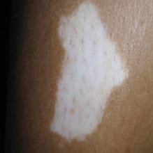 白癜风是由什么因素构成的呢