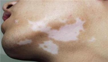 白癜风病发时会有什么症状呢