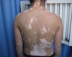 白癜风治疗期间需要患者注意的是什么呢