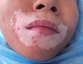 脸上长了白斑要怎么做好日常的护理呢