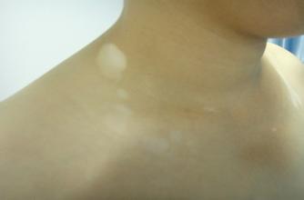 白癜风怎么诊断是正确的呢 白癜风怎么诊断是正确的呢.jpg