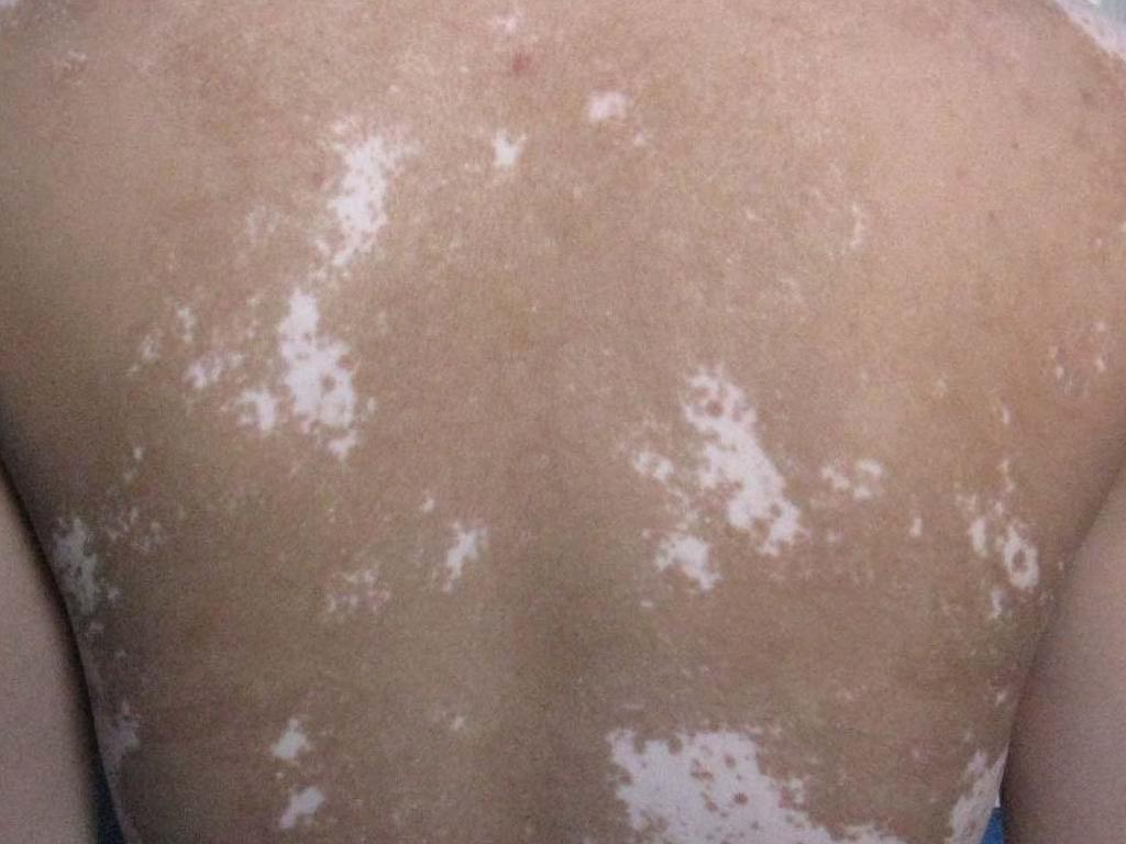 什么原因导致成年人白癜风的呢